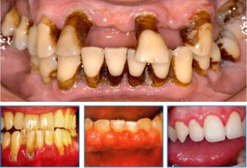 Hình ảnh sâu răng viêm lợi