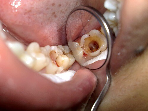 hình ảnh về sâu răng